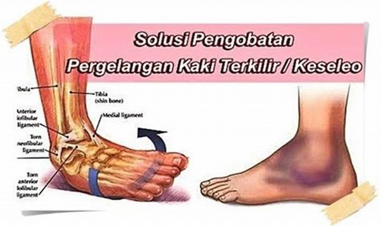 Cara Mengatasi Kaki Keseleo